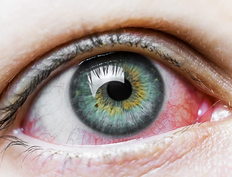 pink eye