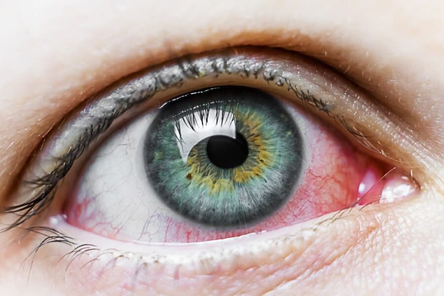 pink eye