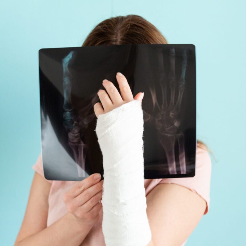 how to set a broken bone