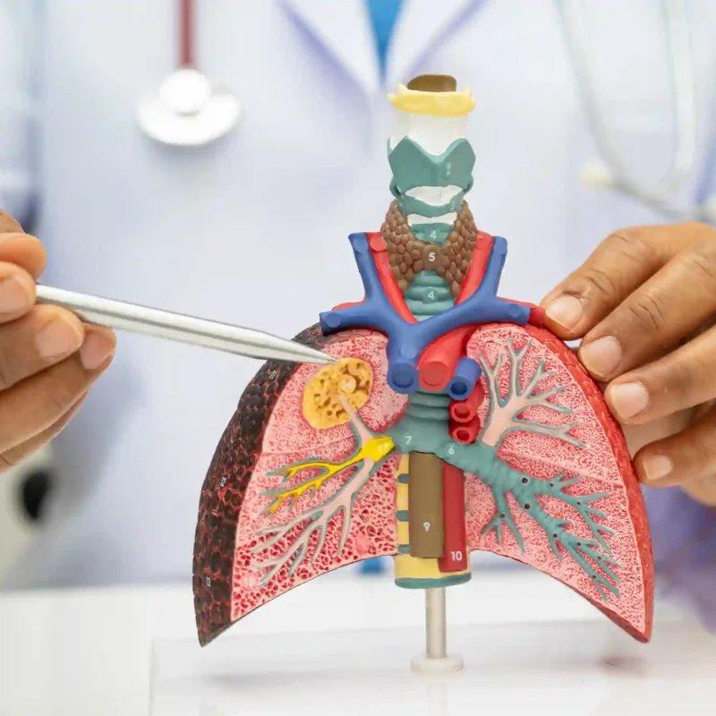 bronchitis treatment